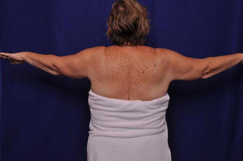 Arm Lift Before & After Gallery - Patient 302270 - Image 2