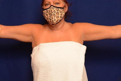 Arm Lift Before & After Gallery - Patient 283025 - Image 1