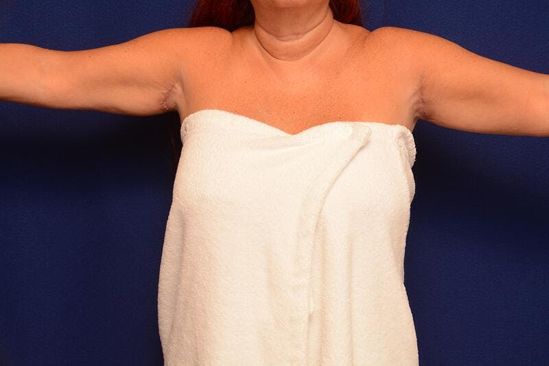 Arm Lift Before & After Gallery - Patient 283025 - Image 2