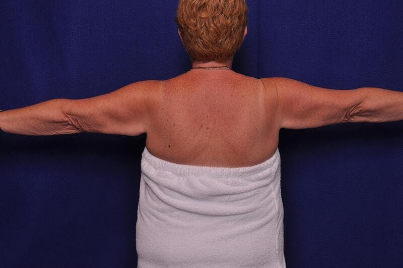 Arm Lift Before & After Gallery - Patient 296146 - Image 1
