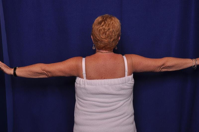 Arm Lift Before & After Gallery - Patient 296146 - Image 2