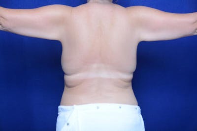 Arm Lift Before & After Gallery - Patient 391450 - Image 1