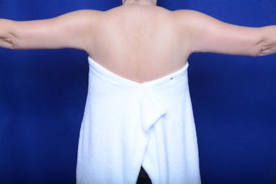 Arm Lift Before & After Gallery - Patient 391450 - Image 2