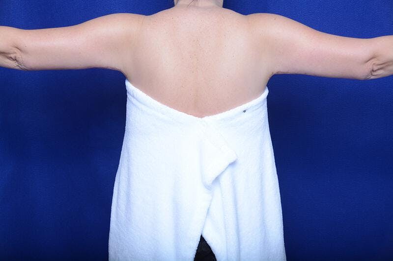 Arm Lift Before & After Gallery - Patient 391450 - Image 2