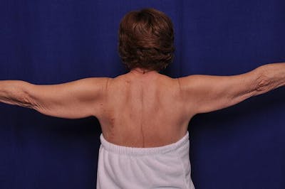 Arm Lift Before & After Gallery - Patient 282298 - Image 1
