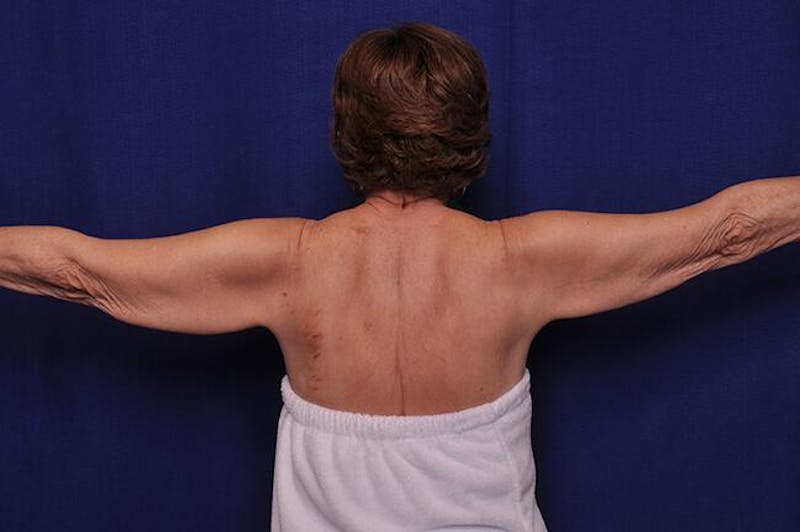 Arm Lift Before & After Gallery - Patient 282298 - Image 1