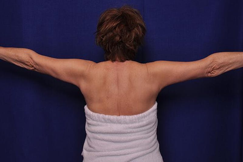 Arm Lift Before & After Gallery - Patient 282298 - Image 2