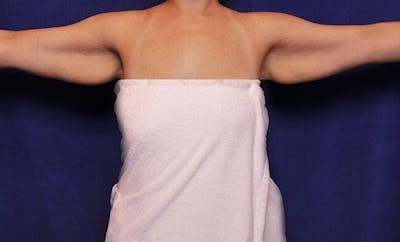 Arm Lift Before & After Gallery - Patient 490991 - Image 1