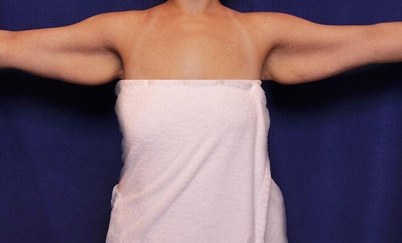 Arm Lift Before & After Gallery - Patient 490991 - Image 1