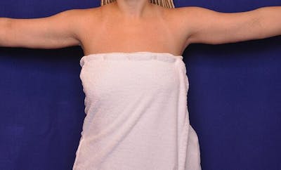 Arm Lift Before & After Gallery - Patient 490991 - Image 2