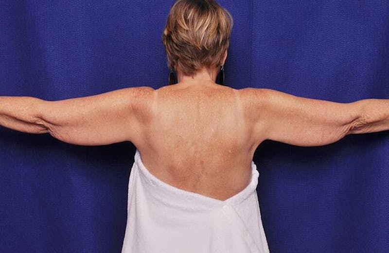Arm Lift Before & After Gallery - Patient 173864 - Image 1