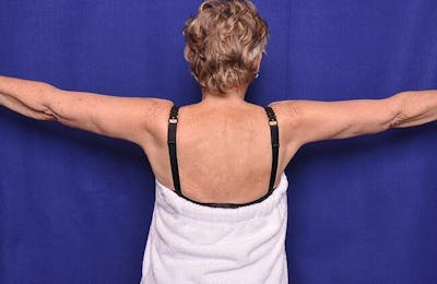 Arm Lift Before & After Gallery - Patient 173864 - Image 2