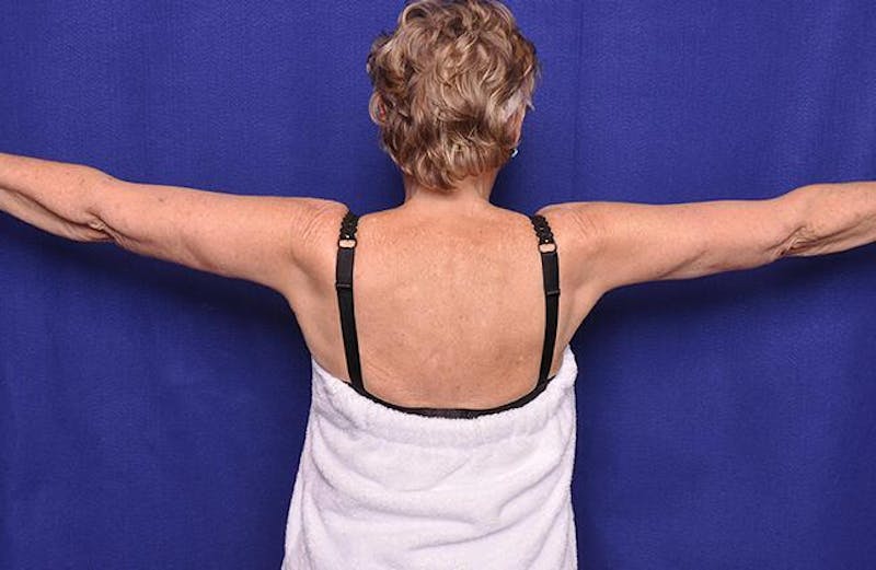 Arm Lift Before & After Gallery - Patient 173864 - Image 2