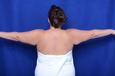 Arm Lift Before & After Gallery - Patient 172376 - Image 1