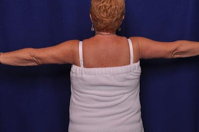 Arm Lift Before & After Gallery - Patient 420202 - Image 2
