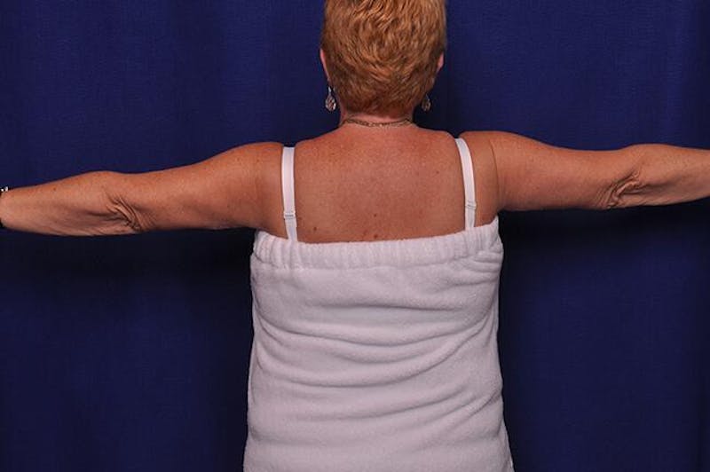 Arm Lift Before & After Gallery - Patient 420202 - Image 2