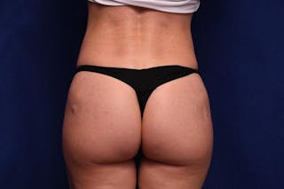 Athletic Gluteal Augmentation Before & After Gallery - Patient 268592 - Image 2