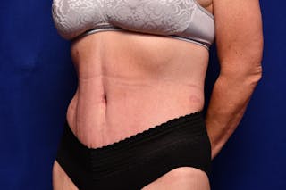 Body Lift Before & After Gallery - Patient 393767 - Image 4