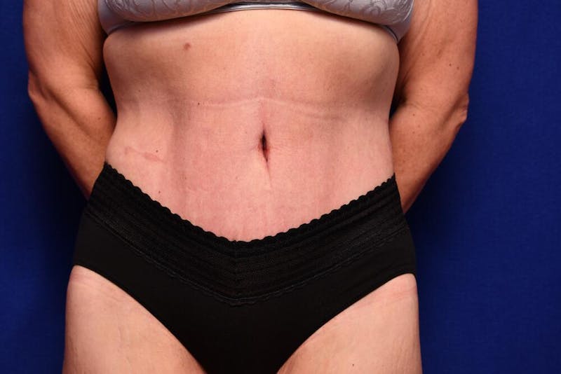 Body Lift Before & After Gallery - Patient 393767 - Image 6