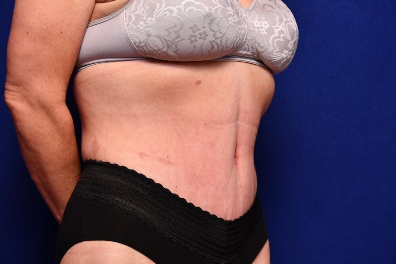 Body Lift Before & After Gallery - Patient 393767 - Image 8
