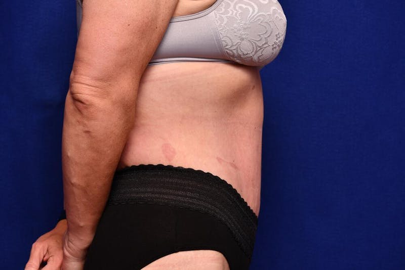 Body Lift Before & After Gallery - Patient 393767 - Image 10