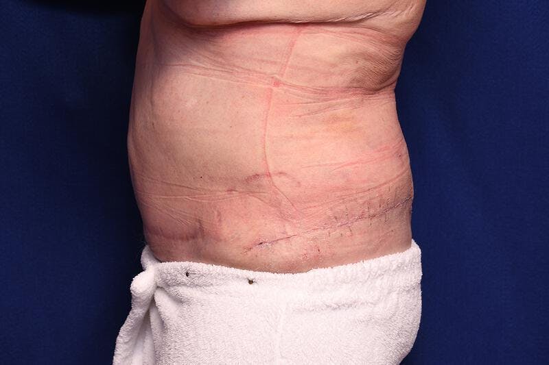 Body Lift Before & After Gallery - Patient 202976 - Image 1