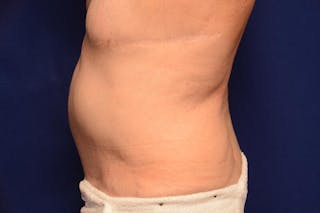 Body Lift Before & After Gallery - Patient 202976 - Image 2