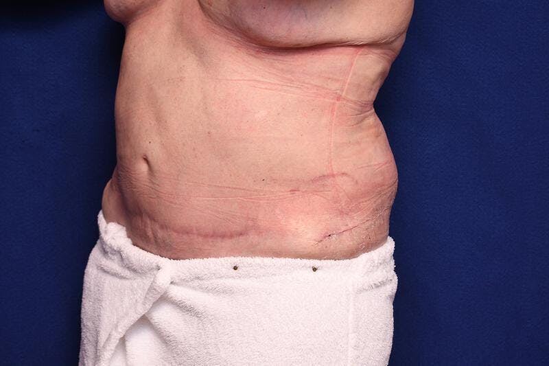 Body Lift Before & After Gallery - Patient 202976 - Image 3