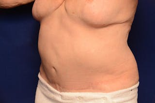 Body Lift Before & After Gallery - Patient 202976 - Image 4