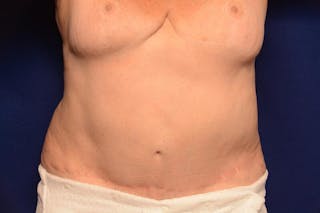 Body Lift Before & After Gallery - Patient 202976 - Image 6