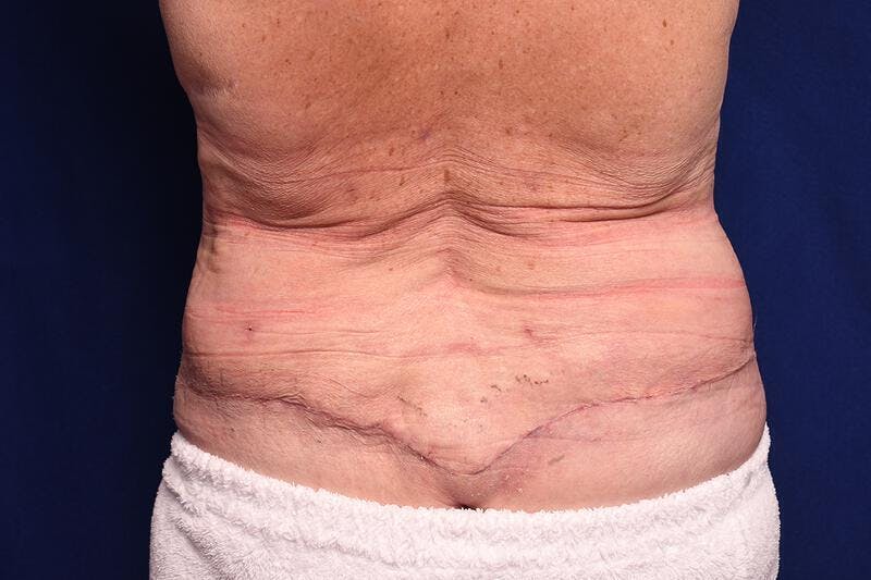 Body Lift Before & After Gallery - Patient 202976 - Image 7