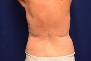 Body Lift Before & After Gallery - Patient 202976 - Image 8