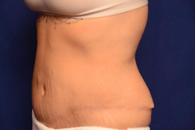Body Lift Before & After Gallery - Patient 328565 - Image 1