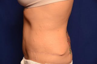 Body Lift Before & After Gallery - Patient 328565 - Image 2