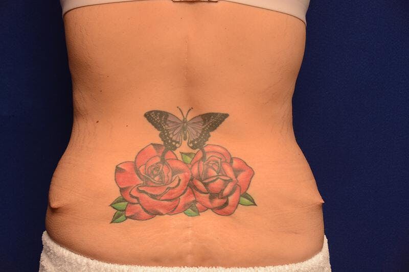 Body Lift Before & After Gallery - Patient 328565 - Image 3