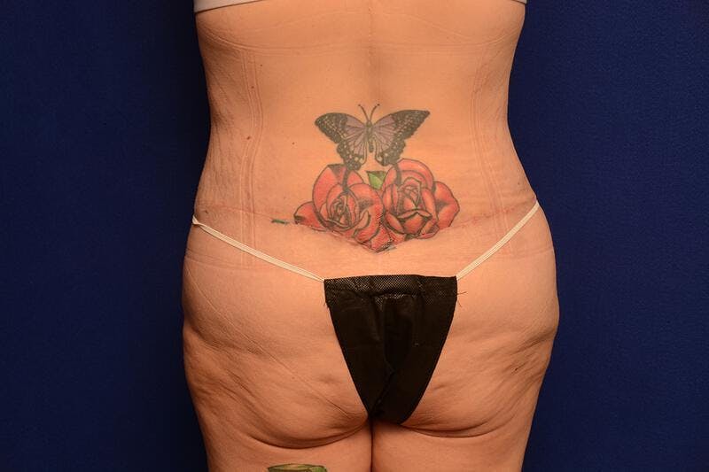 Body Lift Before & After Gallery - Patient 328565 - Image 4