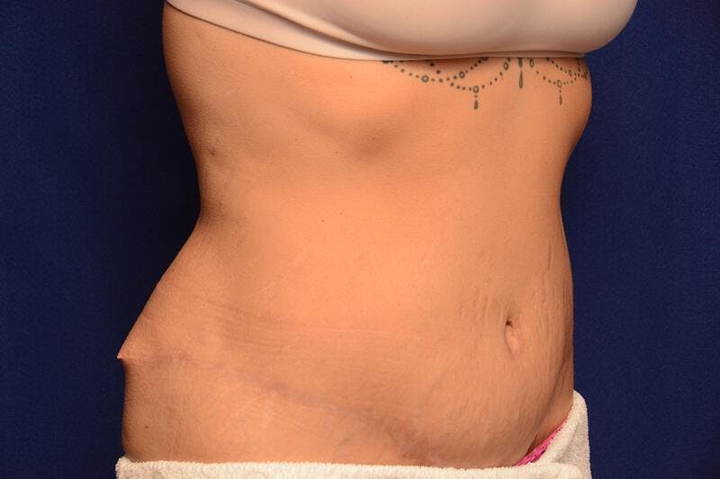 Body Lift Before & After Gallery - Patient 328565 - Image 5