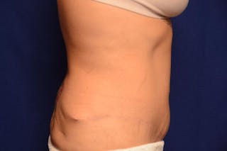 Body Lift Before & After Gallery - Patient 328565 - Image 6