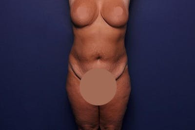 Body Lift Before & After Gallery - Patient 127039 - Image 1