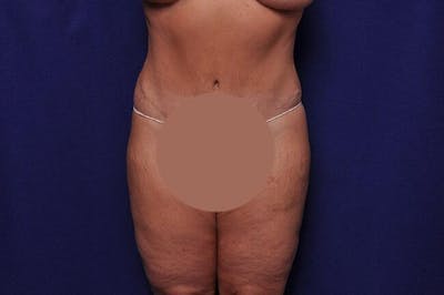 Body Lift Before & After Gallery - Patient 127039 - Image 2