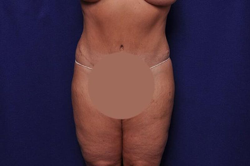 Body Lift Before & After Gallery - Patient 127039 - Image 2
