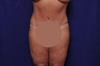Body Lift Before & After Gallery - Patient 127039 - Image 2