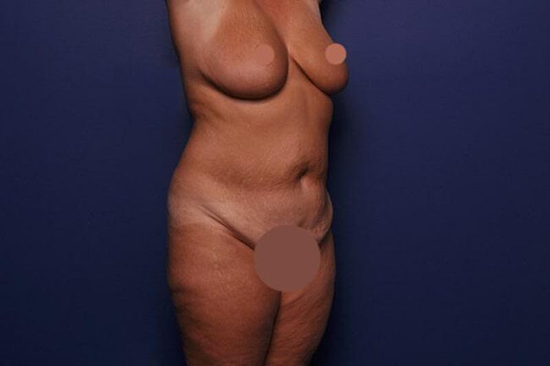 Body Lift Before & After Gallery - Patient 127039 - Image 3