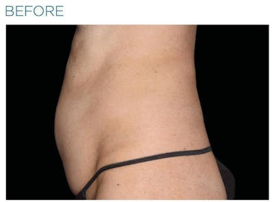 Emsculpt Abdomen Before & After Gallery - Patient 341300 - Image 1