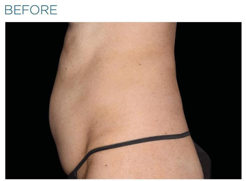 Emsculpt Abdomen Before & After Gallery - Patient 341300 - Image 1