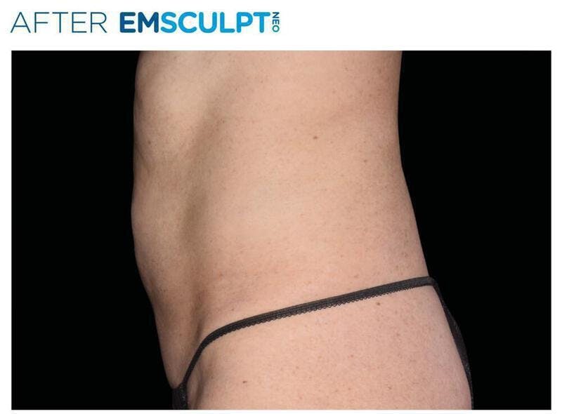 Emsculpt Abdomen Before & After Gallery - Patient 341300 - Image 2