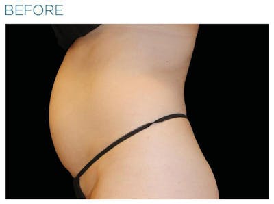 Emsculpt Abdomen Before & After Gallery - Patient 264068 - Image 1