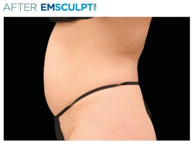 Emsculpt Abdomen Before & After Gallery - Patient 264068 - Image 2