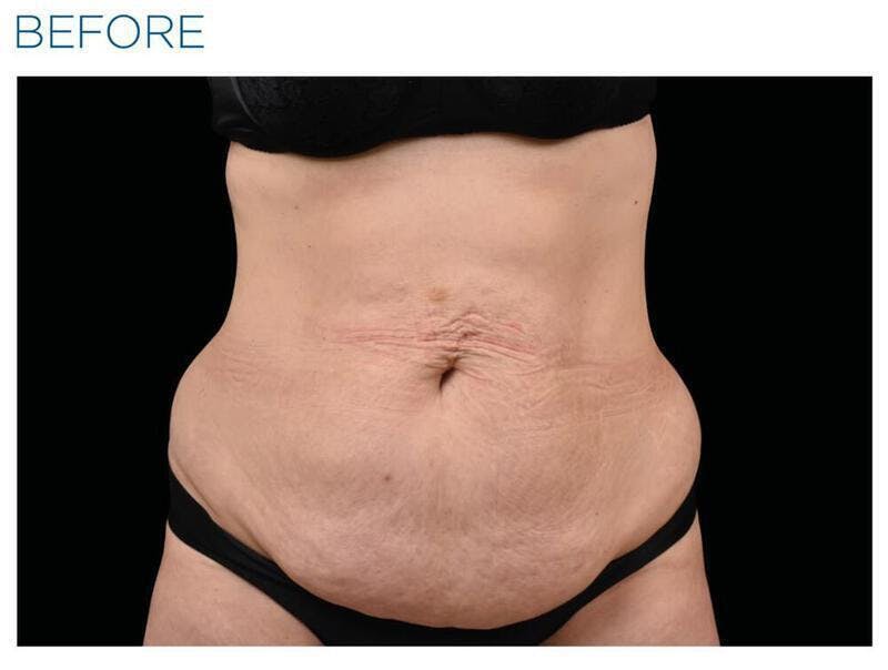 Emsculpt Abdomen Before & After Gallery - Patient 422115 - Image 1