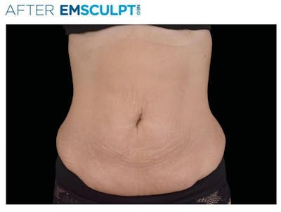 Emsculpt Abdomen Before & After Gallery - Patient 422115 - Image 2